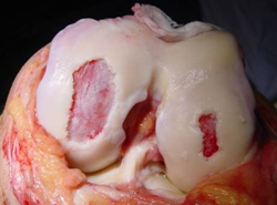 patologia lesiones cartilago