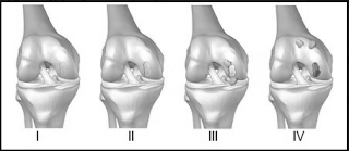 patologia lesiones de cartilago