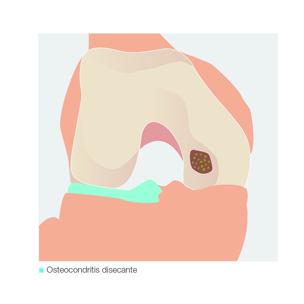 diagnostico osteocondritis disecante